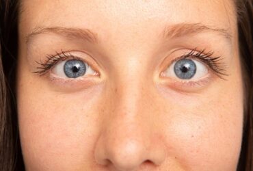 Şaşılık(Gözlerde Kayma)